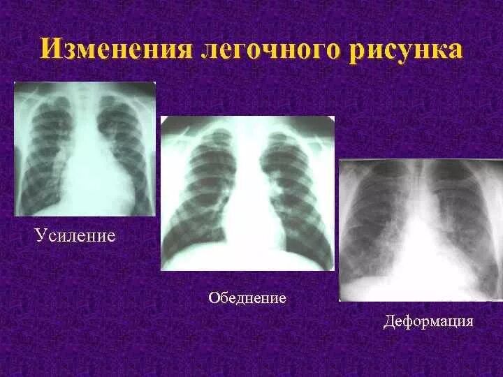 Деформация легочного рисунка на рентгене. Рентген деформация оеговного р сунка. Синдром усиления легочного рисунка. Усиление легочного рисунка.