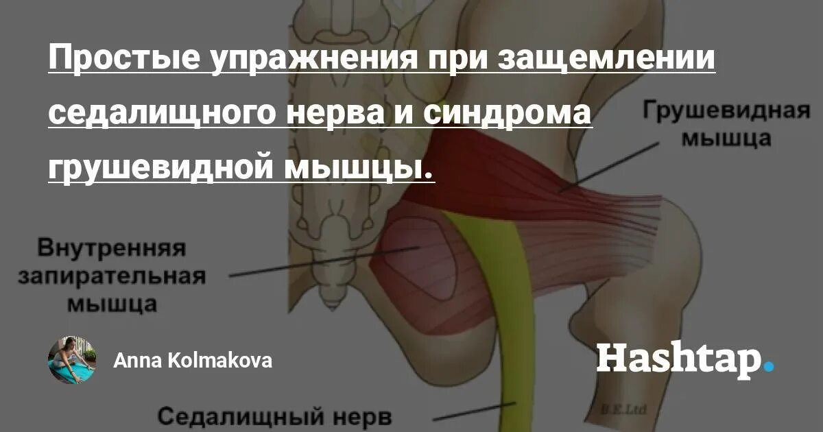 Мышца седалищного нерва. Синдром грушевидной мышцы симптомы. Грушевидный синдром седалищного нерва симптомы. Грушевидная мышца и седалищный нерв. Грушевидная мышца воспаление.