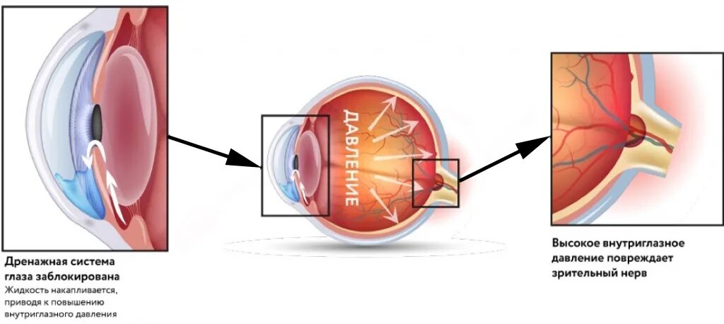 Внутриглазное давление причины. Терминальная глаукома. Стадии глаукомы. Глаз при остром приступе глаукомы. При остром приступе глаукомы зрачок.