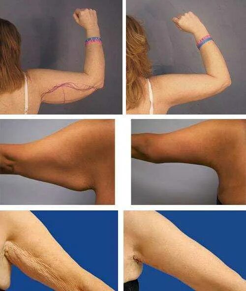 Брахиопластика (пластика рук). Уменьшение рук. Уменьшение рук. Уменьшение рук. Уменьшение рук.