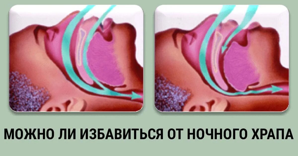 Храп быстро. Причины храпа. причины храпа у женщин.