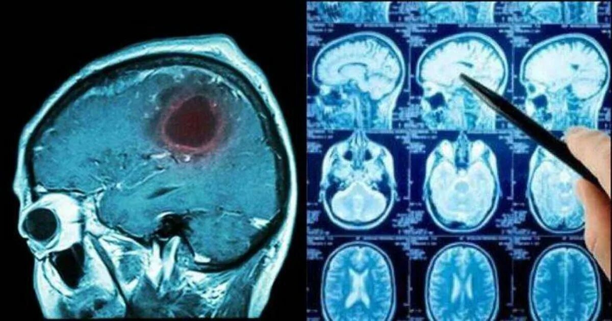 Глиома у детей. Глиома (астроцитома, эпендимома). Опухоль мозга глиобластома. Злокачественная глиобластома головного мозга снимок.