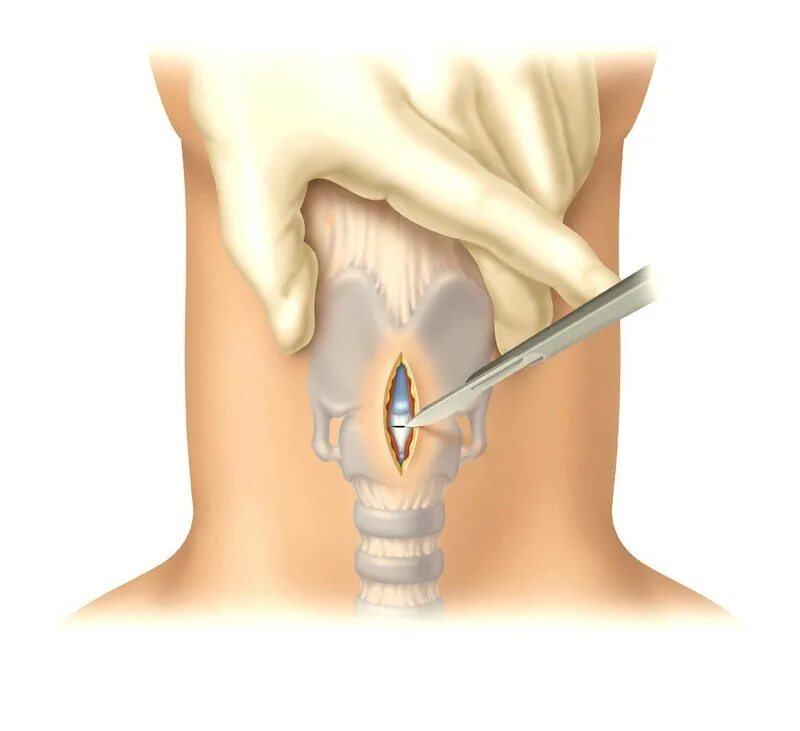 Гортань клиника. Трахеостомия операция. Трахеостомия техника проведения. Трахеотомия трахеостомия коникотомия.