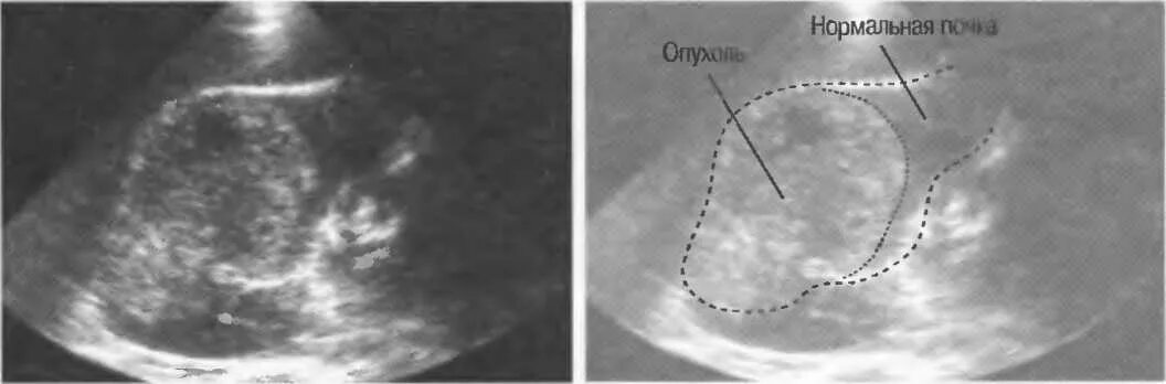 Злокачественная опухоль почки на УЗИ. Опухоль почки снимок УЗИ. Объемное образование в почке на УЗИ что это. Новообразования почки на УЗИ. Видна ли опухоль на узи