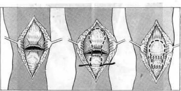 Кисетный шов надколенника. Операция на собственной связки надколенника. Отрыв собственной связки надколенника операция. Шов собственной связки надколенника.