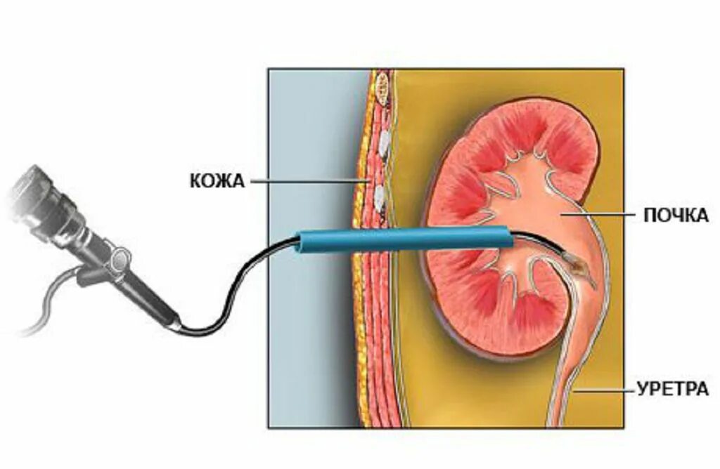 В мочеточнике соли. Ретроградная литотрипсия. Перкутанная нефролитотрипсия операция. Чрескожная литотрипсия камней в почках. Чрескожная перкутанная нефролитолапаксия.
