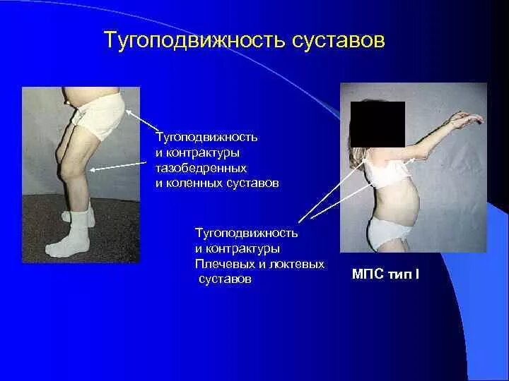 Тугопоподвижность сустава. Тугоподвижность суставов тазобедренных суставов. Контрактура и тугоподвижность сустава. Контрактура сустава код по мкб 10