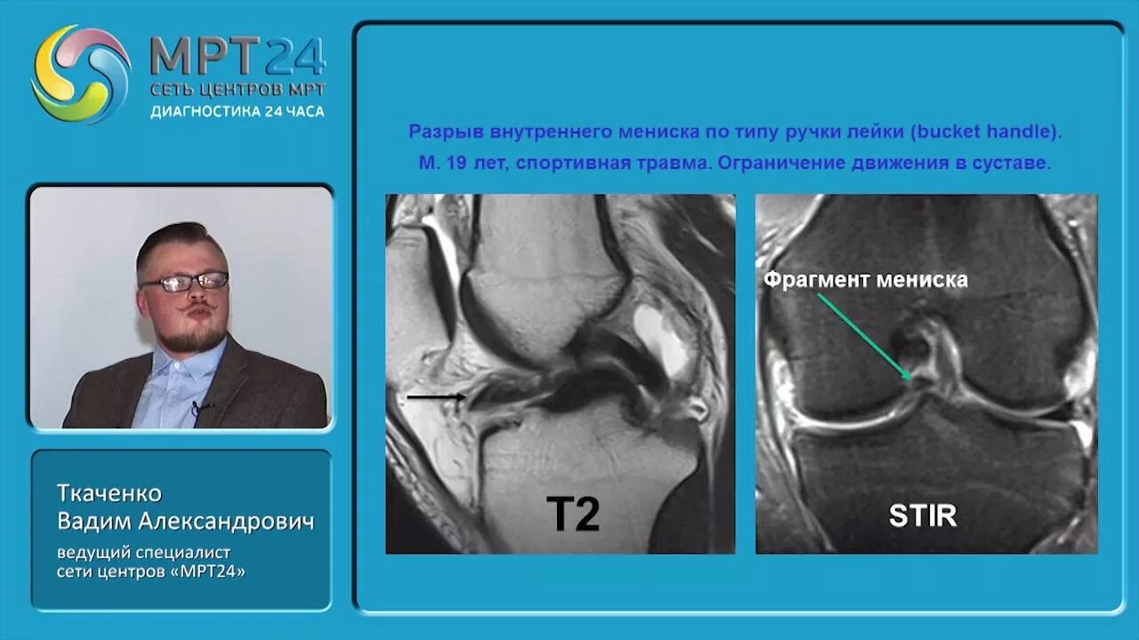Разрыв мениска мрт. Разрыв мениска по типу ручки лейки мрт. Разрыв ручки лейки мениска мрт. Повреждение мениска по типу ручки лейки мрт. Разрыв мениска коленного сустава ручка лейки.