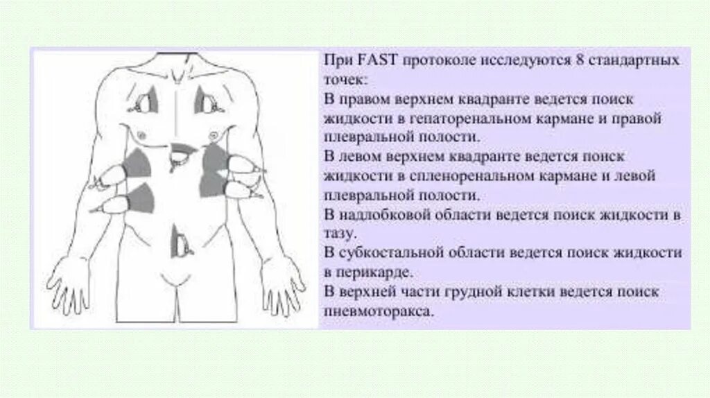 Фаст протокол при травме. Фаст протокол УЗИ. Точки фаст протокола. Fast протокол