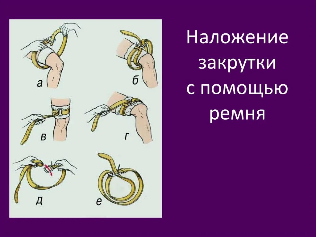 Закрутка при кровотечении
