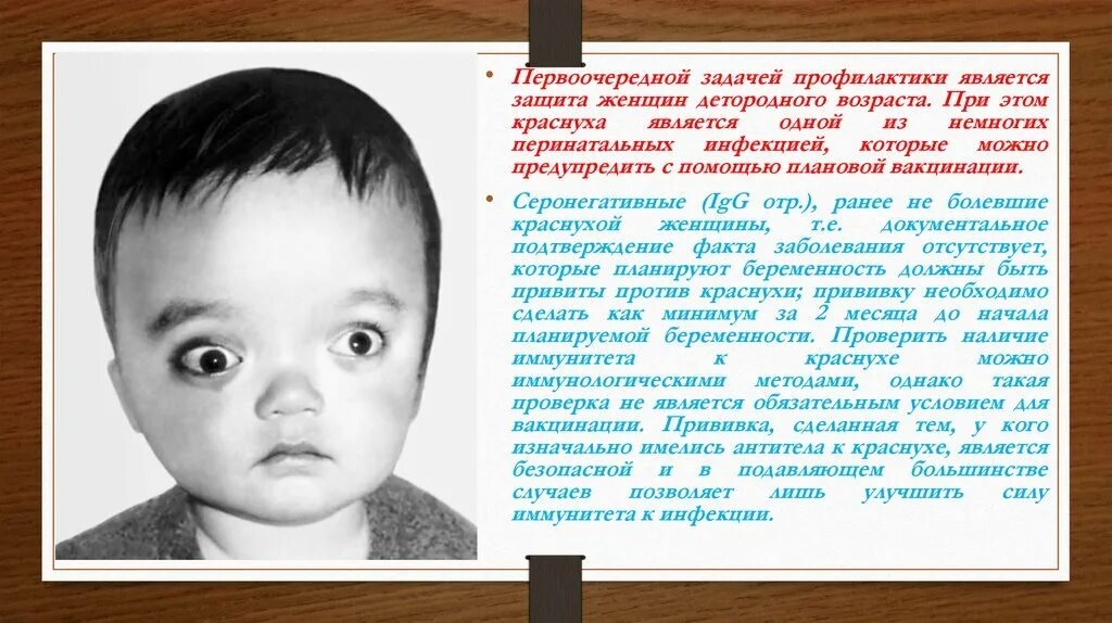 Свинка переболел в детстве. Синдром врожденной краснухи. Врожденная краснуха проявления. Врожденные уродства при краснухе.