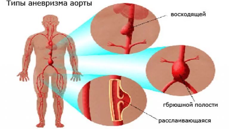 Аорта брюшной полости операция. Аневризма инфраренального отдела брюшной аорты. Атеросклероз аорты с аневризмой. Атеросклероз брюшной аорты. Симптомы аневризмы брюшной аорты.