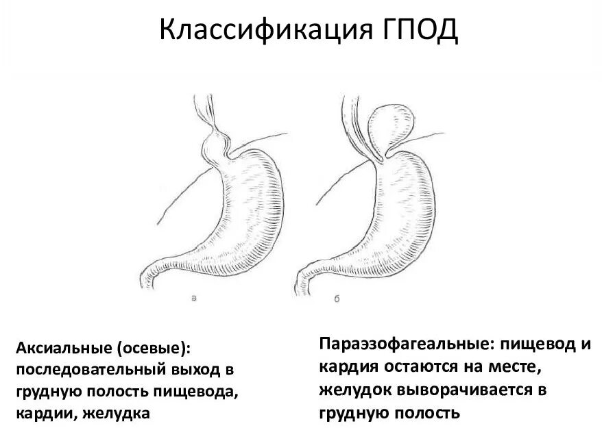 Грыжа под как лечить. Аксиальные грыжи пищеводного отверстия диафрагмы классификация. Аксиальная грыжа пищеводного отверстия. Грыжи переднего отдела диафрагмы классификация. Грыжа пищеводного отверстия диафрагмы 1 типа.