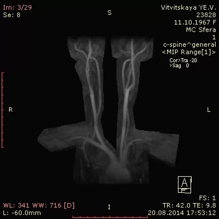 высокое вхождение позвоночных артерий в канал. сегменты v1 v2 позвоночных артерий. позвоночная артерия сегменты анатомия. V2 сегменты позвоночных артерий норма. высокое вхождение позвоночной артерии.