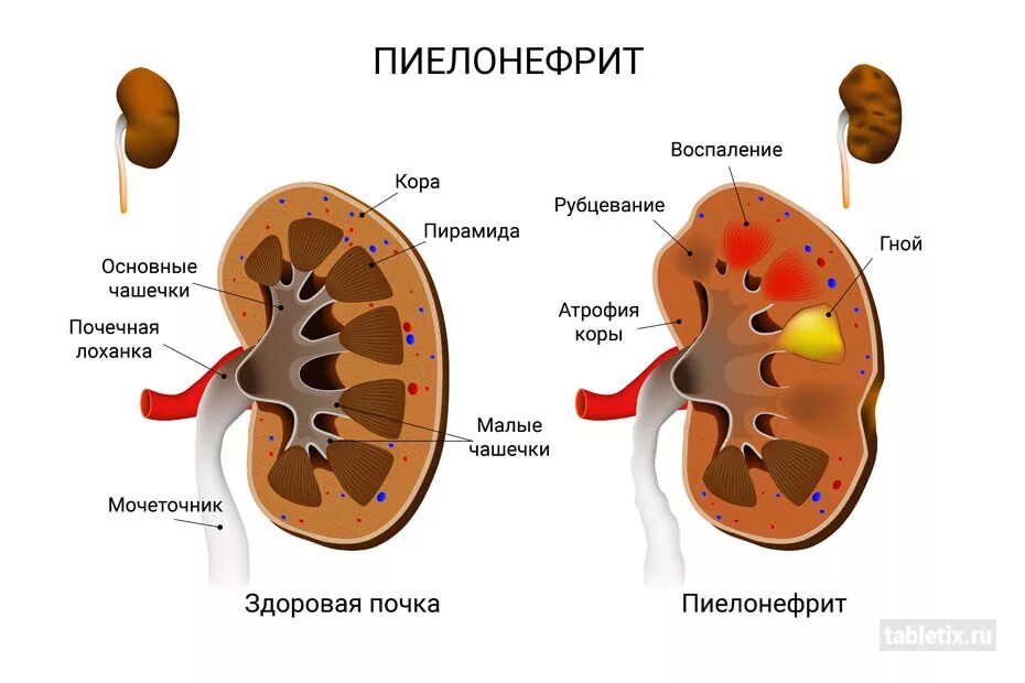 Почки лоханка причины. Болезнь почекпилонефрит. Болезнь почек пиелонефрит. Строение чашечно лоханочной системы почек. Патология почки. Пиелонефрит.