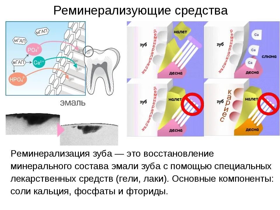 Чувствительность зубов после лечения. Реминерализация эмали зубов: методы и средства. Алгоритм реминерализующей терапии эмали зубов. Реминерализующая терапия электрофорез. Препараты для реминерализующей терапии кариеса.