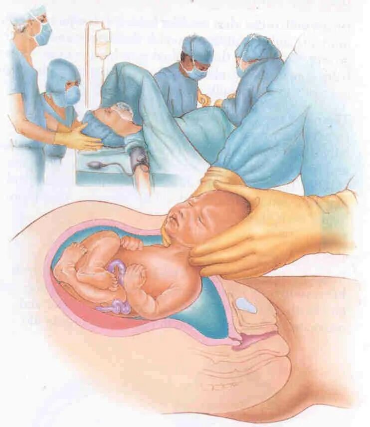 Кесарево в анамнезе. Операция кесарево Сечени. Рождение ребенка кесарево сечение.