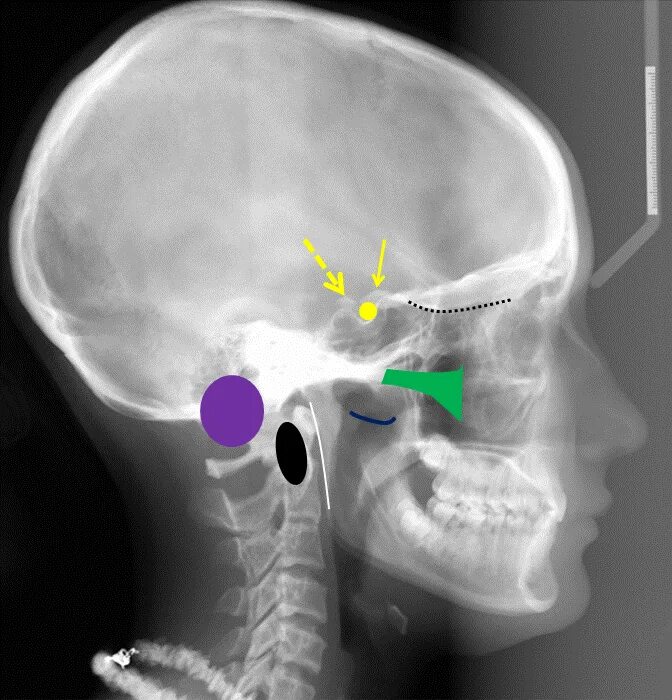 Отросток мозга 4. Рентген сосцевидного отростка височной кости. Сосцевидный отросток височной кости кт. Височная кость черепа рентген. Рентген сосцевидного отростка.