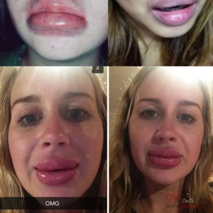 Что нельзя делать после процедуры губ. Неудачное увеличение губ. Увеличенные губы фото до и после.