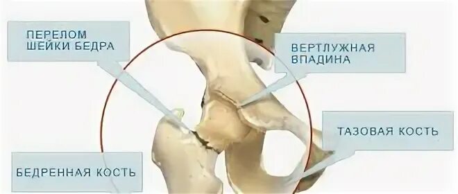 Перелом шейк бедра в пожилом возрасте