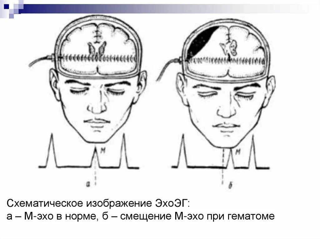 Эхо гостомеля. Эхоэнцефалоскопия головного мозга норма. Эхоэнцефалограмма головы норма показатели. Эхоэнцефалография результат. Эхоэнцефалография показания.