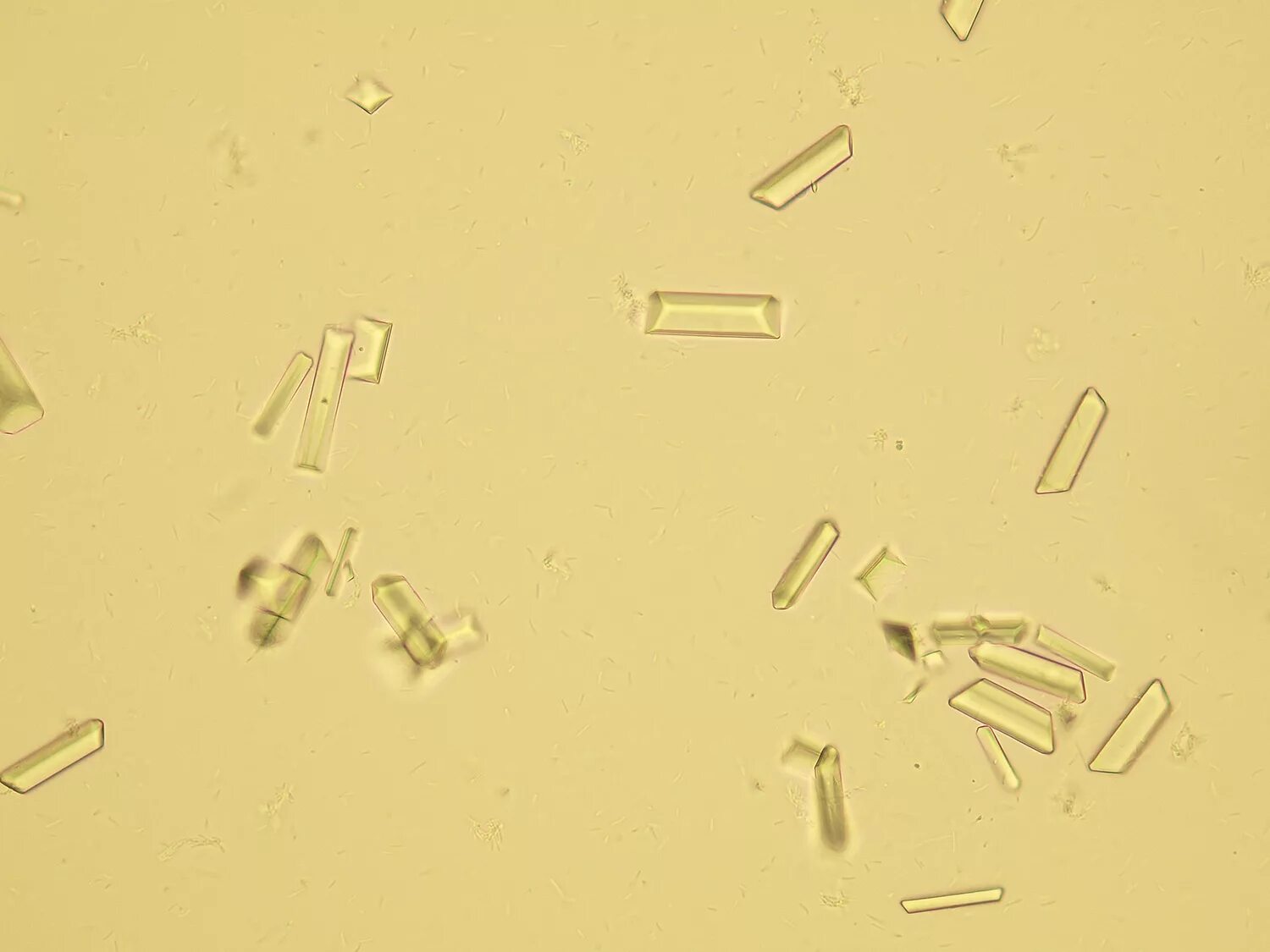 Кристаллы оксалата в моче у мужчин. Струвиты оксалаты трипельфосфаты. Струвиты и оксалаты. Струвиты микроскопия. Кристаллы трипельфосфаты в моче.