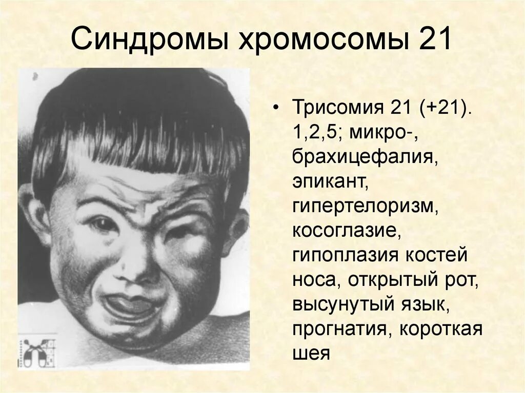 Синдром Патау (трисомия 13-й хромосомы). Синдром хромосомные трисомия. Болезнь с лишней хромосомой