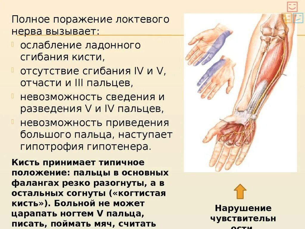 Заболевание мышц рук. Нейропатия локтевого нерва клиника. Невропатия локтевого нерва симптомы. Поражение сенсорных волокон нервов верхних конечностей. Поражение локтевого нерва руки.