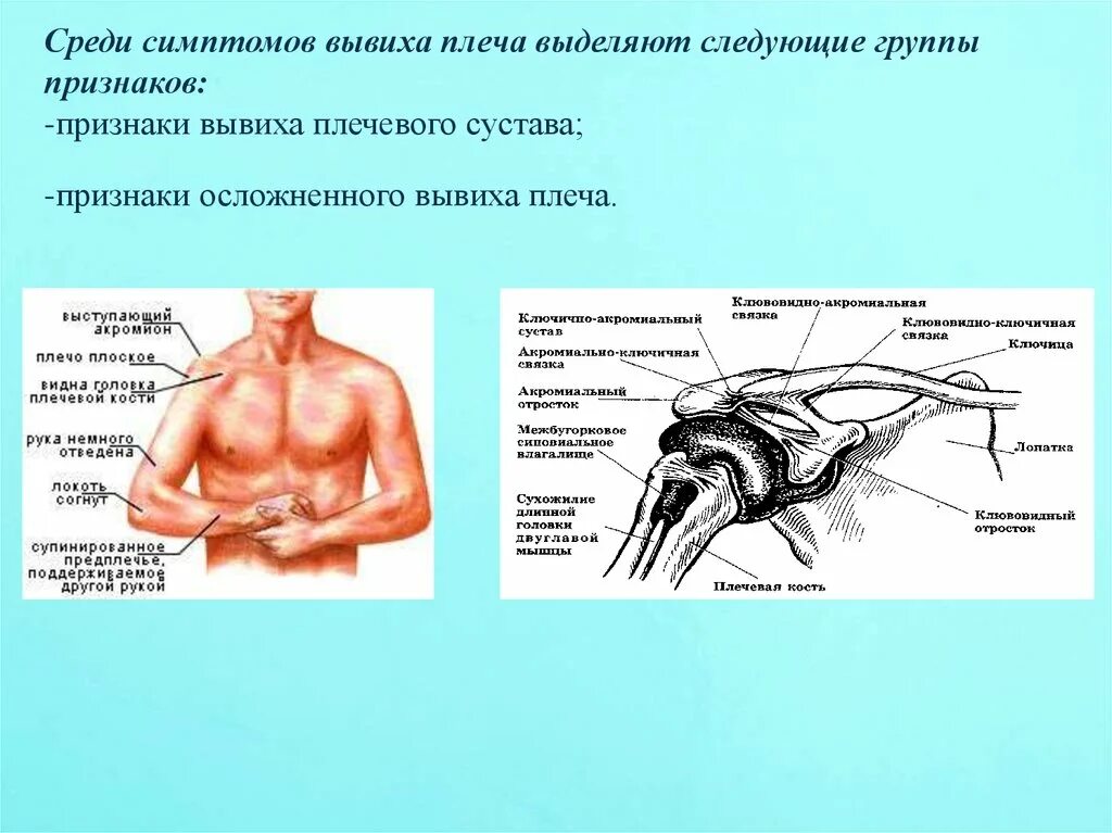 Вывих плечевого сустава карта вызова СМП. Вывих плечевого сустава симптомы. Симптомы при вывихе плечевого сустава. Признаки вывихнутого плеча. Разрыв плечевого сустава симптомы