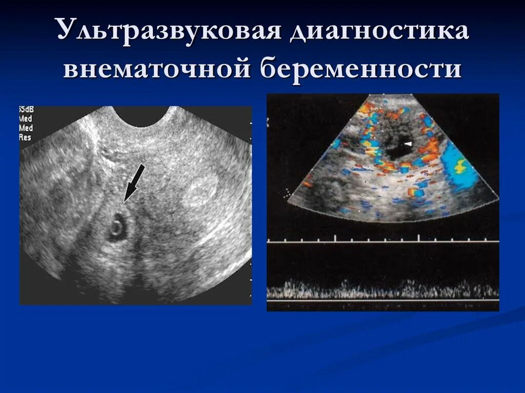 Диагноз внематочная беременность. Внематочная Трубная беременность УЗИ. УЗИ признаки трубной беременности. Внематочнаябкременность УЗИ. Внематочная беременность на УЗИ.