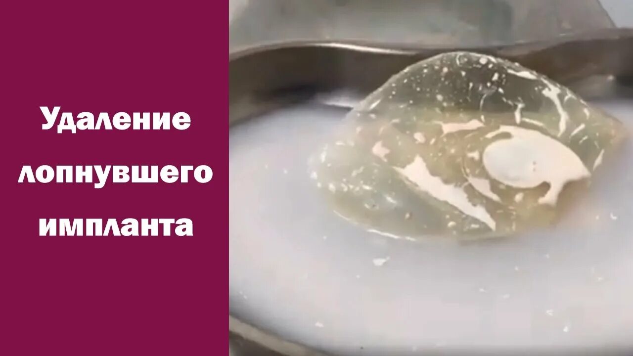 Удалить импланты молочных