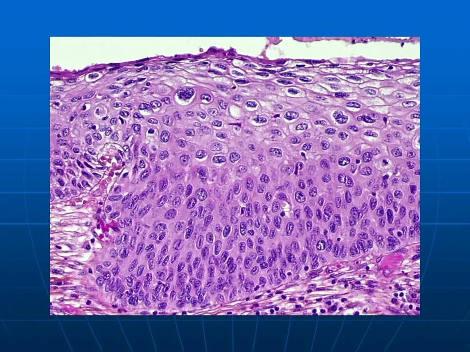 Клетки эпителия шейки матки гистология. Плоский эпителий гистология. Дисплазия шейки матки гистология.