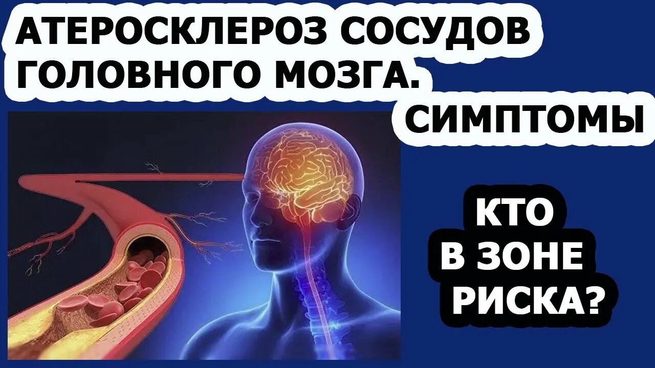 Атеросклероз церебральных сосудов симптомы. Атеросклероз сосудов головного МОЗ. Атеросклероз сосудов головного мозга симптомы. Атеросклероз артерий мозга. Атероматоз сосудов головного мозга.