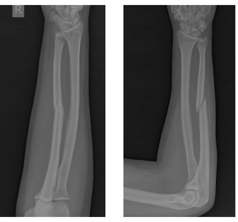 Смещение кости на руке без перелома. Рентген перелома кости предплечья. Перелом диафиза локтевой кости рентген. Перелом средней трети локтевой кости. Антеградный остеосинтез стержнем перелома локтевой кости.