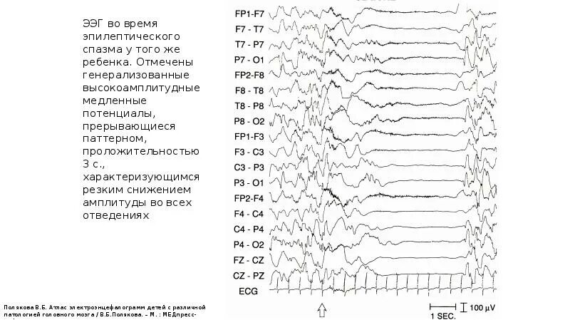 Потенциал ээг. ЭЭГ при разных психических расстройствах. Эпилепсия на ЭЭГ. ЭЭГ при судорогах у новорожденных. Электроэнцефалограмма отведения.