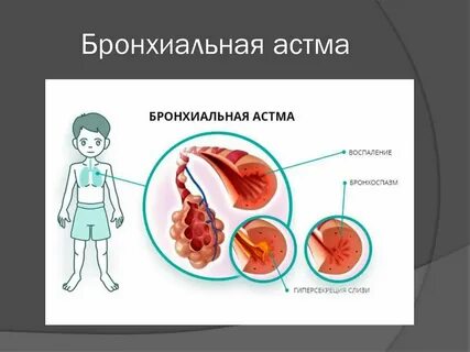Воспаление астмы