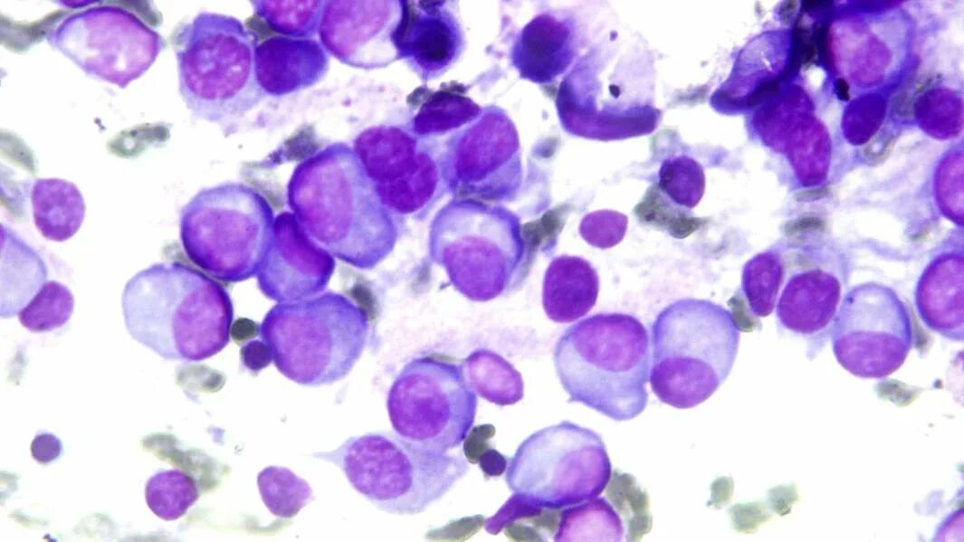 1 плазматическая клетка. Лимфогранулематоз цитология. Плазматические клетки в мазке крови. Плазматические клетки плазмоциты. Плазматические клетки в микроскопе.