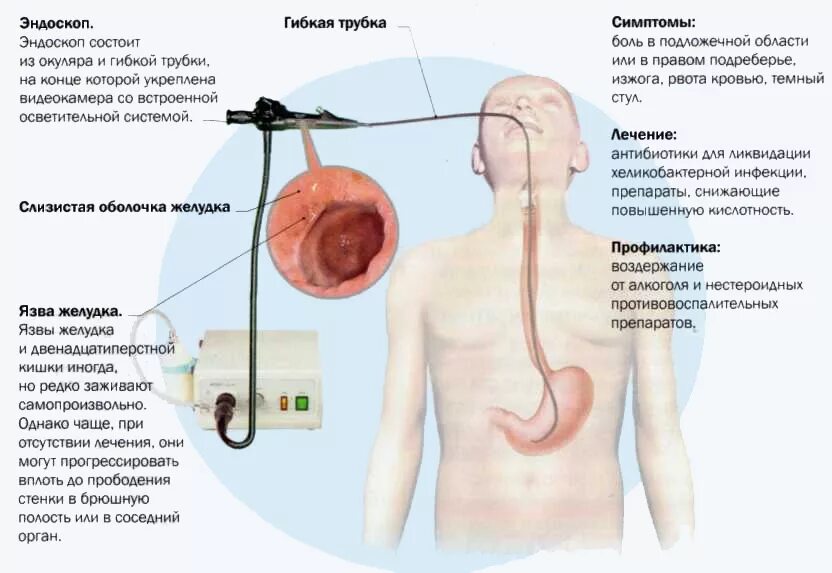 Язвенная болезнь желудка симптомы. Тяжело дышать давит на грудную. Болит при язвенной болезни желудка. Боли в желудке обследование