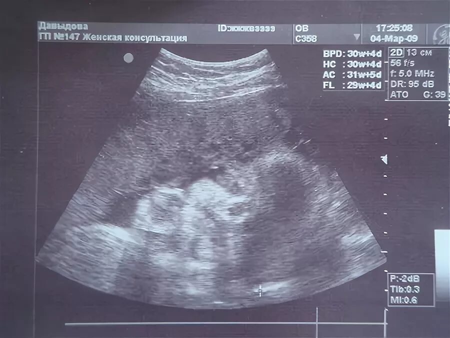 Снимки УЗИ беременности на 30 неделе. Фото УЗИ 30 недель беременности.