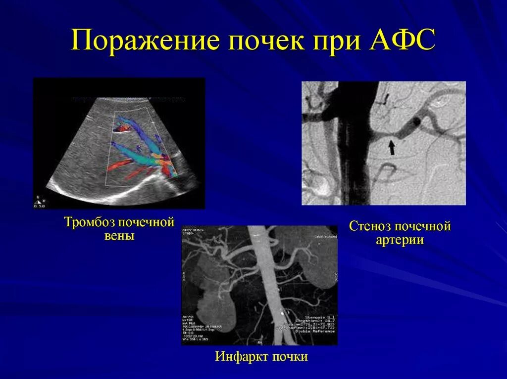 Поражения почек при АФС. Поражение почек при первичном и вторичном АФС. Антифосфолипидный синдром (АФС). Тромбоз почечной артерии. Тромбоз почечной вены