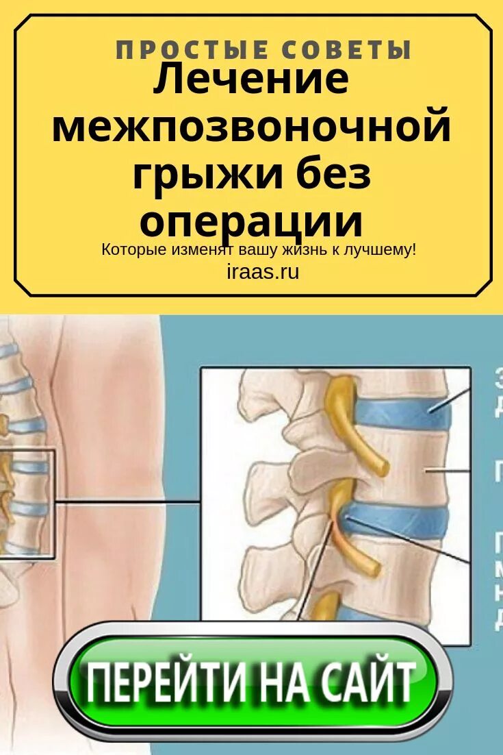 Межпозвоночная грыжа. Лекарство для грыжи позвоночника. Грыжа позвоночника без операции. Грыжа поясничного отдела.