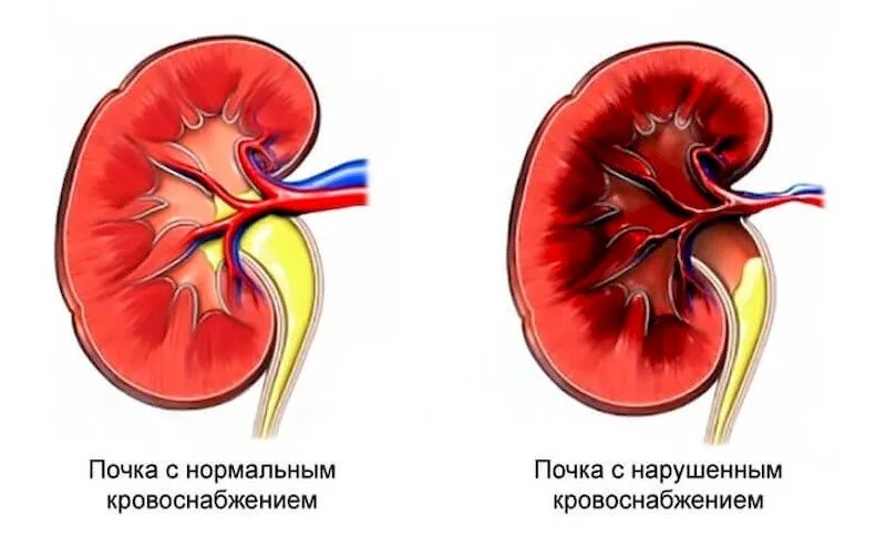 Ишемия почек. Микрососудистый тромбоз в почках. Тромбоз почечной артерии. Нарушение кровотока в почках. Нарушение кровообращения почек.