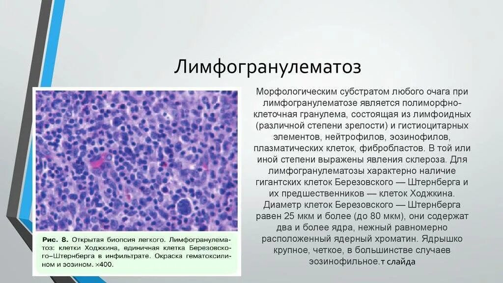 Воспаление ткани латынь. Опухолевые клетки при л. Лимфома Ходжкина гистология. Клетки Ходжкина и Березовского-Штернберга. Многоядерные клетки Березовского-Штернберга.