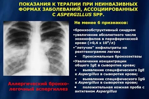 Аспергиллез лечение