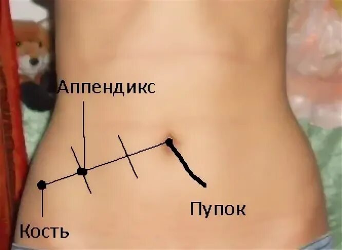 Аппендицит в 2 года. Где находится аппендикс у детей. Где находится аппендицит у ребенка. Расположение аппендицита.