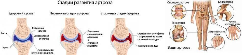 Нарушения коленного сустава. Остеоартроз артрит 1 степени. Остеоартроз (деформирующий остеоартроз). Стадии воспаления сустава. Деформирующий остеоартроз 3 стадии.