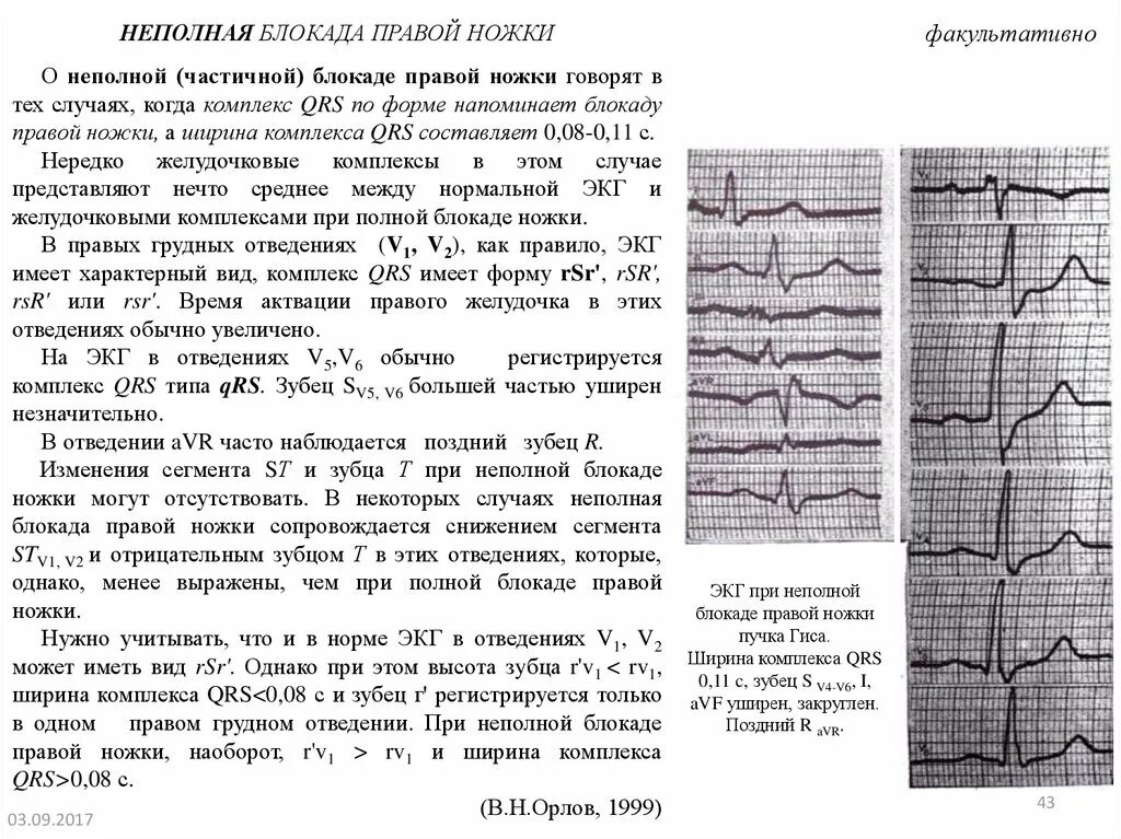 Qrs на экг что это. Блокада правой ножки отведения. Блокада правой ножки на ЭКГ. Неполная блокада правой ножки пучка Гиса. Блокада правой ножки сердца на ЭКГ.