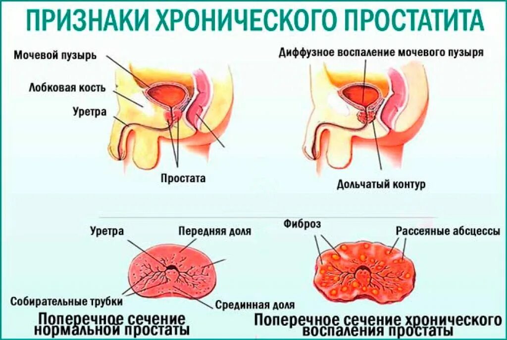 Воспалился простатит. Хронический простатит. Простатотис. Воспалительные заболевания предстательной железы.