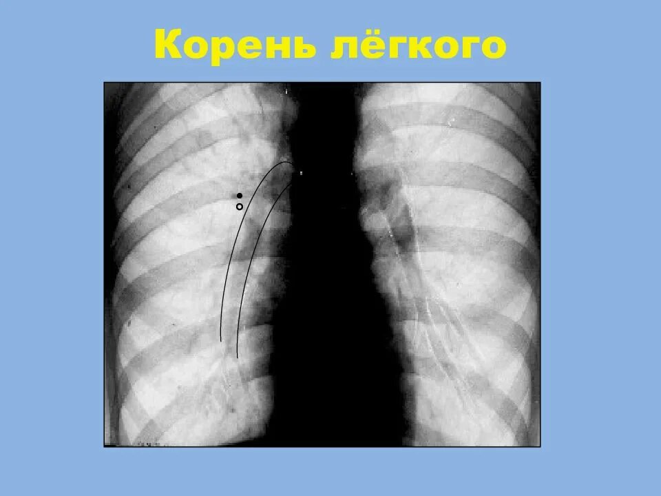 Корни усилены тяжисты. Флюорография органов грудной клетки. Корни усилены тяжисты. Корни легких на рентгене. Легочный рисунок тяжист что это такое.