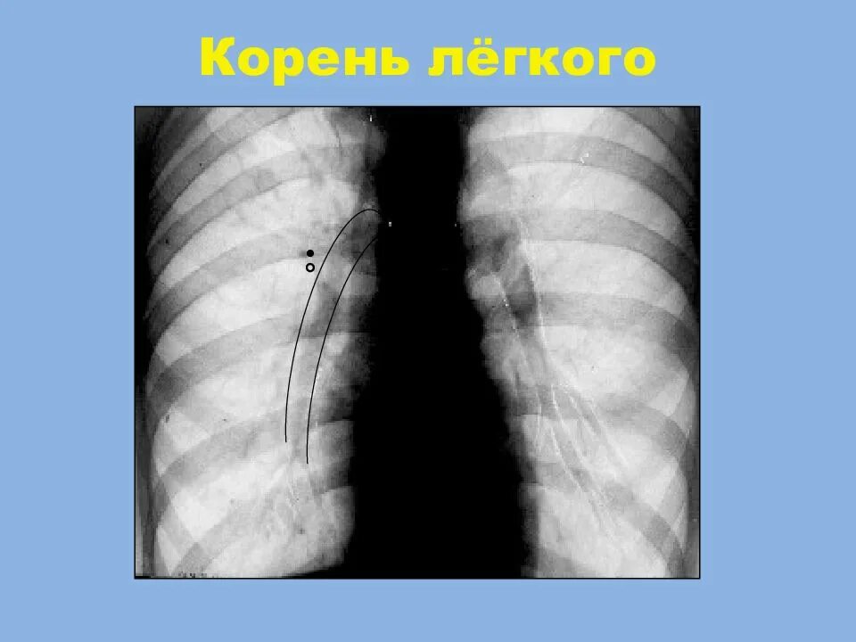 Корень легкого рентген. Расширение корня легкого. Расширение корня легкого на рентгене. Корень легкого уплотнен что значит